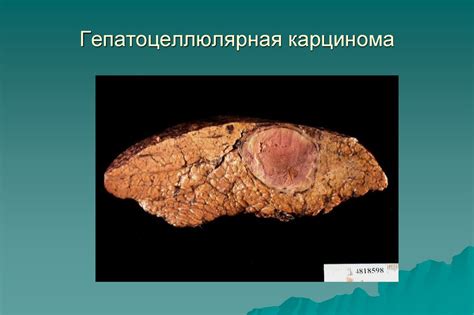 Болезни печени и желчного пузыря - презентация онлайн