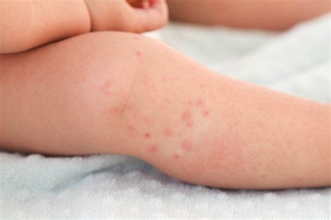Pediatric Skin & Food Allergies in Singapore | The Skin Drs