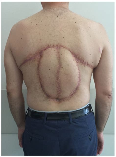 reverse bilateral latissimus dorsi flap reconstruction  extensive