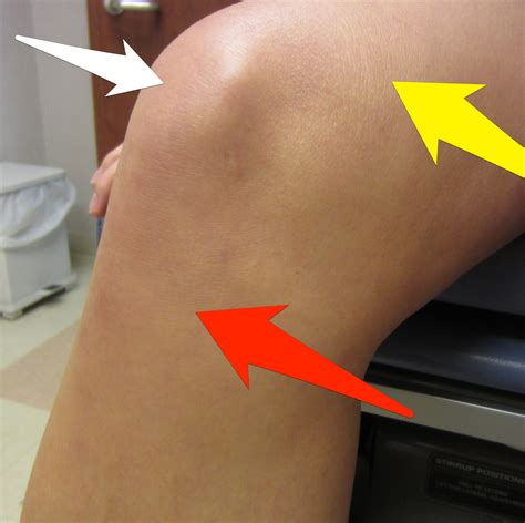 Marcus Lattimore: Initial thoughts on gruesome knee injury | Dr Geier