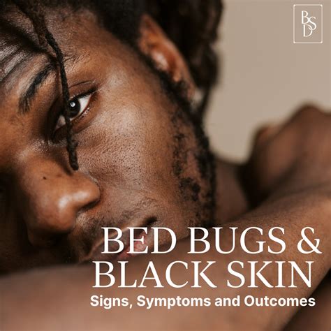 How do bed bug bites look on Black skin? — Black Skin Directory