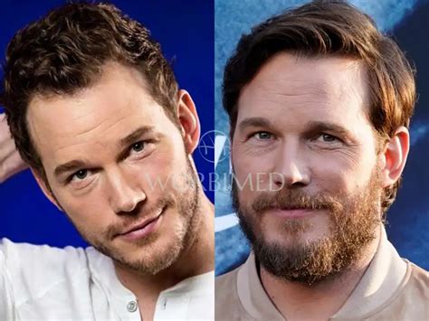 Chris Pratt Hair Transplant | Before and After
