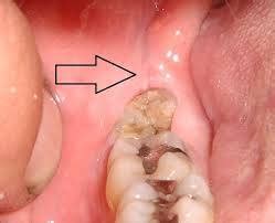 How long is Recovery Period after Wisdom tooth Removal? | NDA