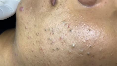 Experts Warn: This Unbelievable Blackhead Removal 2024 Trend is Dangerous! - 5bwump9