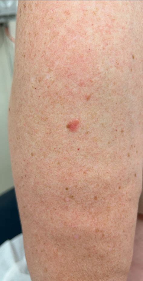 skin cancer moles  arms