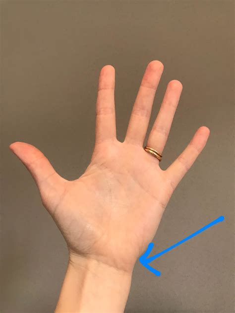 Wrist Pain Ulnar Side TFCC & Ulnar Side Wrist Injuries — Rayner