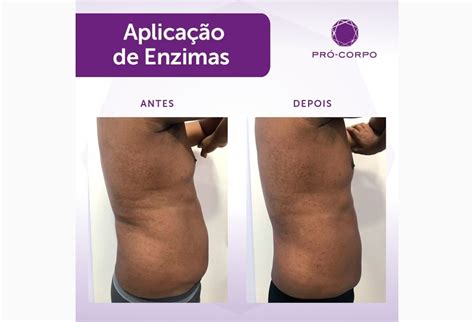 Lipo Enzimática Antes E Depois 1 Sessão