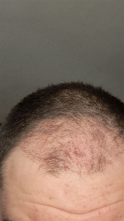 Hair transplant wound update. 2 months later : r/HairTransplants