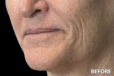 Laser Skin Rejuvenation Before & After - Precision Aesthetics Medical ...