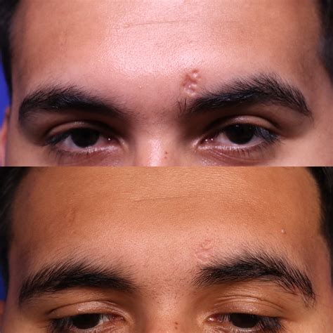 Atrophic Scar Treatment Before and After