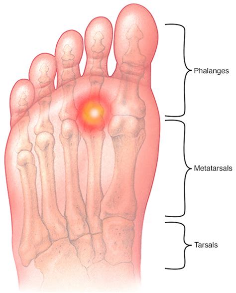 TRANSFER METATARSALGIA – Caribbean Orthopaedic Foot and Ankle Institute