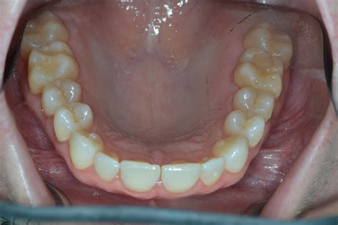 normal soft palate