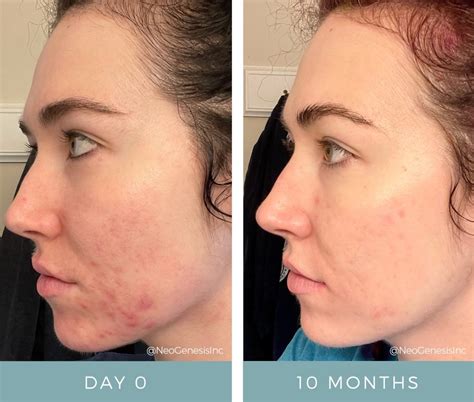 Before After Hormonal Acne NeoGenesis Products Acneic Skin