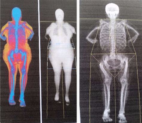 DEXA Scan | flid-fit