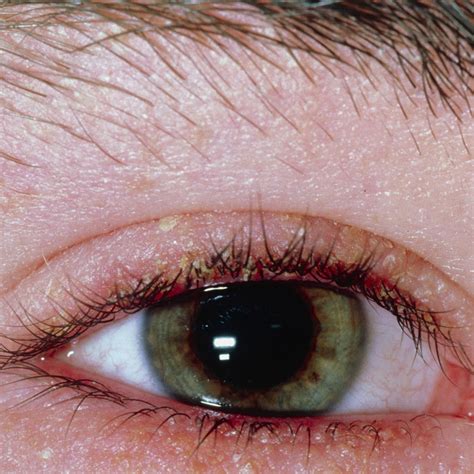 Anterior Blepharitis What is Anterior Blepharitis? Causes & Treatment ...