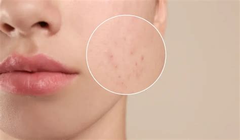 Causes and Solutions to Treat Hormonal Acne Without Using Birth Control!