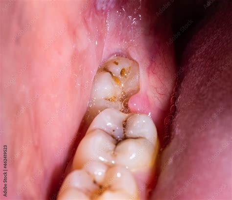Impacted Wisdom Teeth