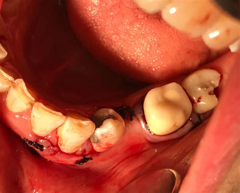 Mental foramen... - The Dental Implant Learning Center