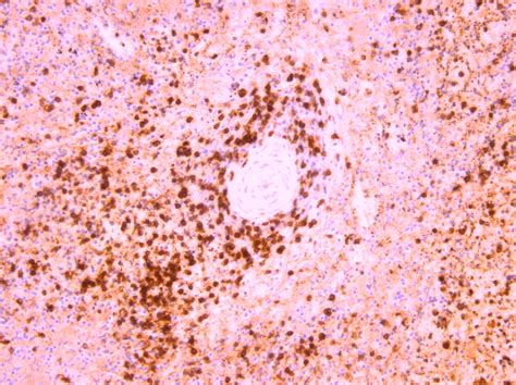 CD3 adjacent to arterioles. CD3 immunostaining, ×200. | Download ...