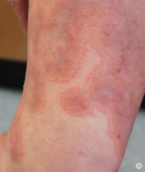 Vesiculobullous Eruptions