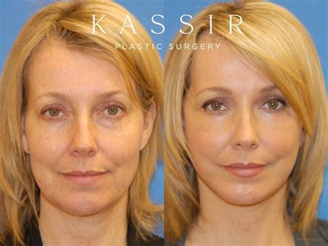 Before and After Facelifts. All healing stages and tips for a quick recovery — Kassir Plastic ...