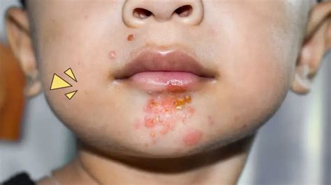 mengenal impetigo penyebab gejala   mengobatinya orami