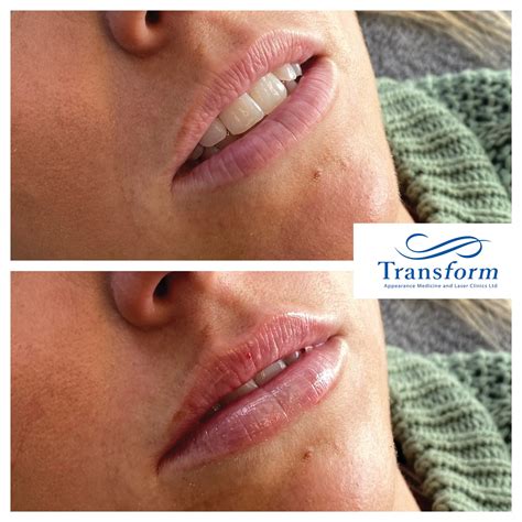 Lu... - Transform Clinic | Appearance Medicine & Laser Clinics