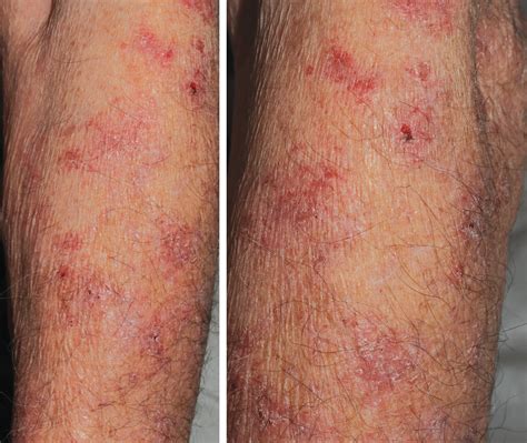 Arm And Hand Rash at Cheryl Talley blog