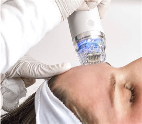 rf fractional microneedling  malta transform  skin