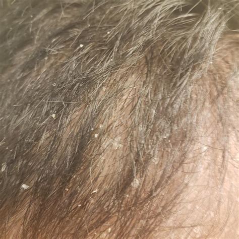 Dry skin or dandruff? : r/dandruff