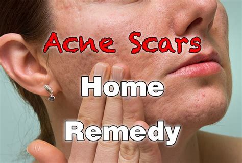 Acne Scars Home Remedy - Healthy Focus