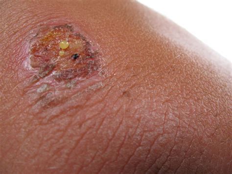 17+ How To Know If Wound Is Infected 2022 | Hutomo