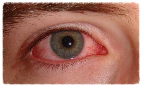 AZ Red Eye Experts - Advanced Treatment for Chronically Red Eyes ...