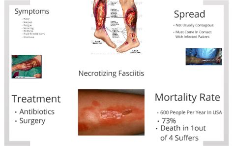 Necrotizing Fasciitis by Jake Bezon on Prezi