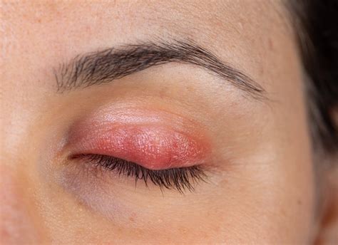 how long does it take for blepharitis to go away