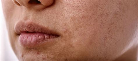 sallow skin  experts guide     treatments  pink