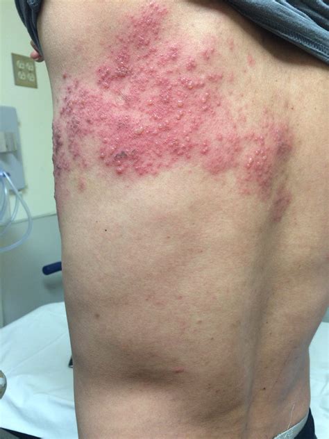 Picture of: picture of herpes