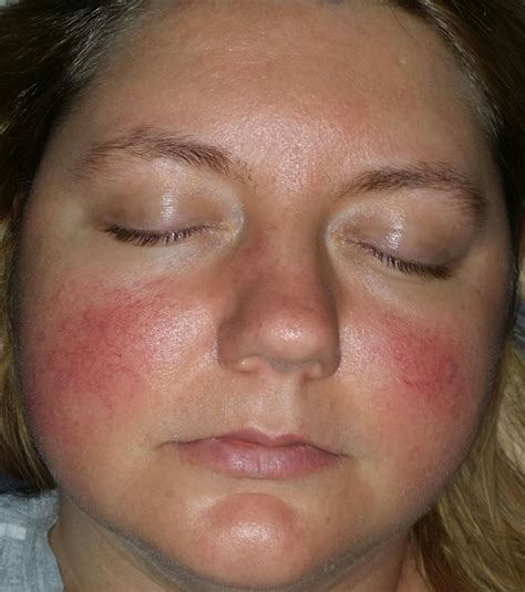 Is it rosacea? – Rosacea & facial redness – Acne.org Forum