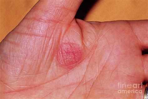 Burn Blister Photograph by Jane Shemilt/science Photo Library - Fine ...