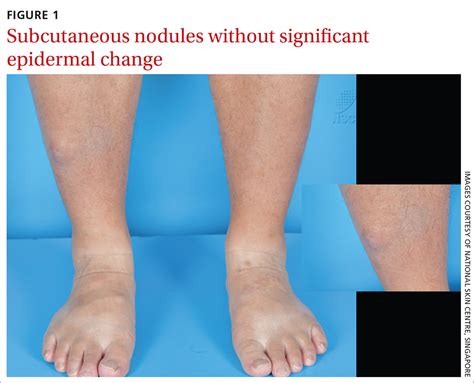 painless nodules  legs mdedge family medicine