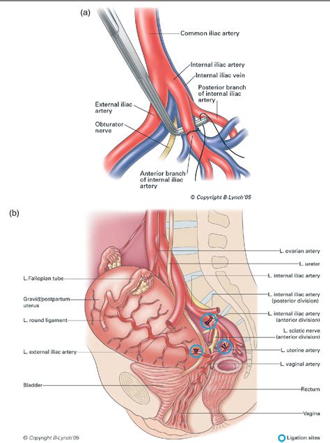 Table 1 from Internal Iliac ( Hypogastric ) Artery Ligation | Semantic Scholar