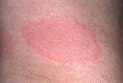 Lyme Disease Symptoms Rash