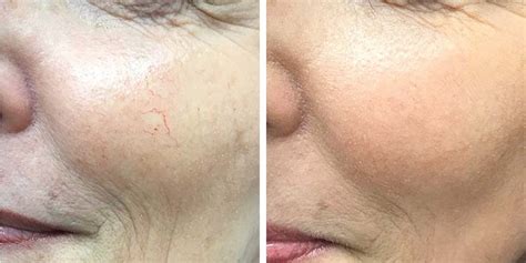 complexion dr papantoniou dermatologist  long island