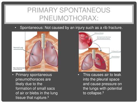 PPT - C31 Pneumothorax PowerPoint Presentation, free download - ID:586391