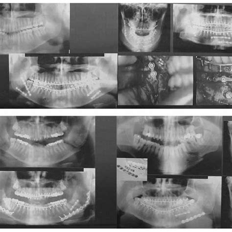 (PDF) New innovations in craniomaxillofacial fixation: The 2.0 lock system