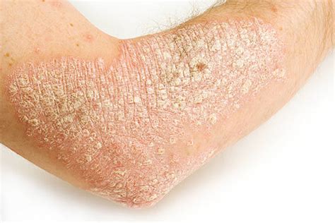 Biologic Therapy for Psoriasis may Increase Risk of Certain Skin Cancers - Contemporary ...