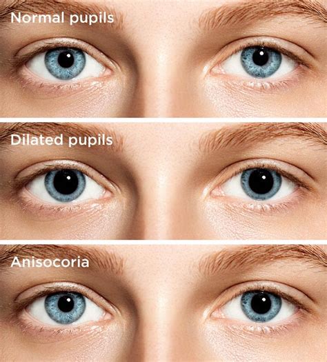 dilated pupils pupil dilation  symptoms