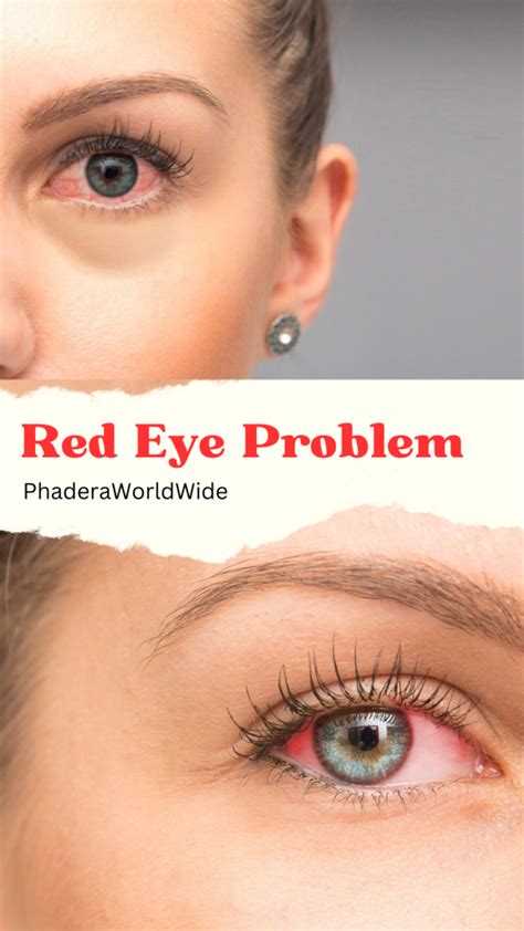 Red Eye Matters: Empowering Primary Care for Clear Vision - Phadera ...