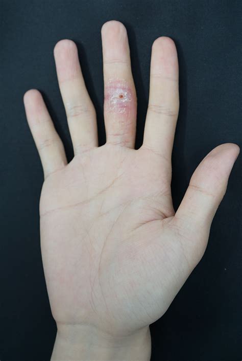 A chronic painless plaque on the finger | The BMJ