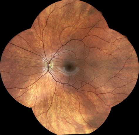 dilated eye exams explained kindsight eye specialists